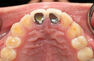 bruxism-clenching-grinding-before-after-1