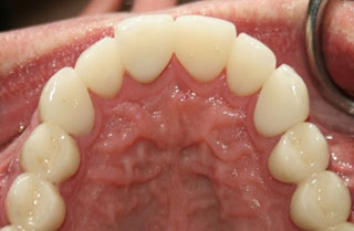 bruxism-clenching-grinding-before-after-2