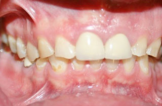 bruxism-clenching-grinding-before-after-3