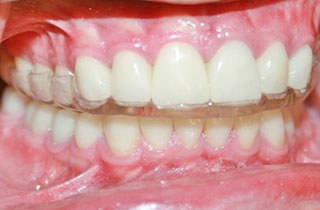 bruxism-clenching-grinding-before-after-4