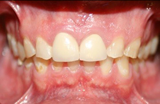 crown-reconstructions-before-after-1