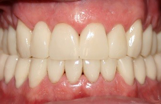 crown-reconstructions-before-after-10