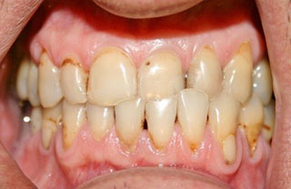 crown-reconstructions-before-after-11
