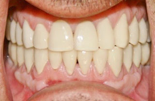 crown-reconstructions-before-after-12