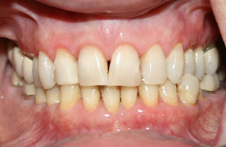 crown-reconstructions-before-after-13