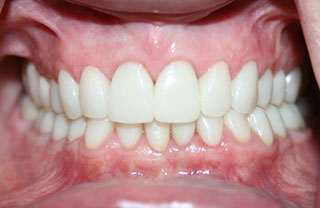 crown-reconstructions-before-after-14
