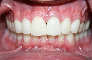 crown-reconstructions-before-after-2