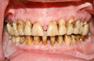 crown-reconstructions-before-after-3