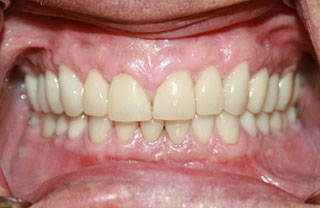 crown-reconstructions-before-after-4