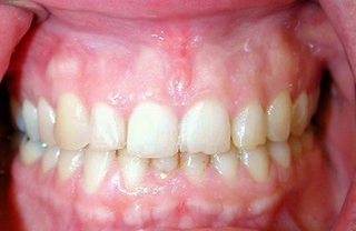 crown-reconstructions-before-after-5