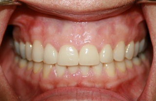 crown-reconstructions-before-after-6