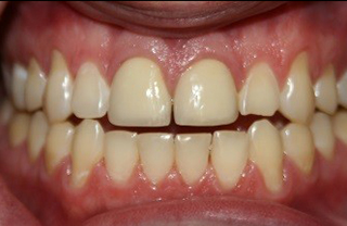 crown-reconstructions-before-after-7