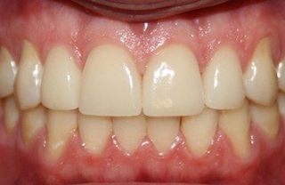 crown-reconstructions-before-after-8