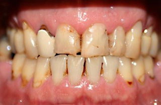 crown-reconstructions-before-after-9