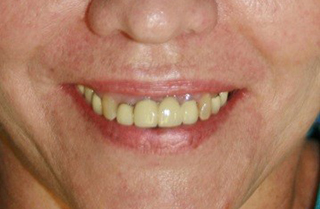 dental-implants-before-after-1