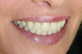 dental-implants-before-after-10