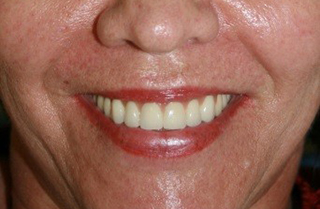 dental-implants-before-after-2