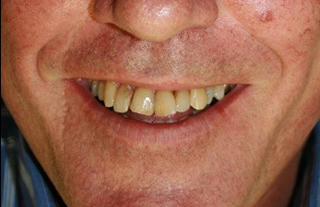 dental-implants-before-after-3