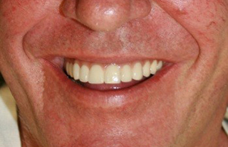 dental-implants-before-after-4