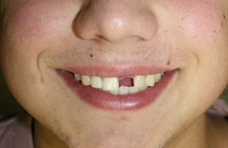 dental-implants-before-after-5