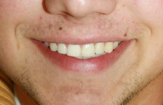 dental-implants-before-after-6