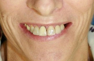 dental-implants-before-after-7