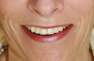 dental-implants-before-after-8