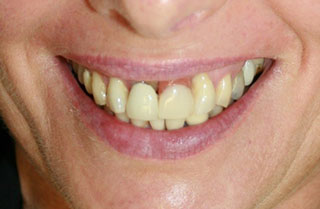 dental-implants-before-after-9