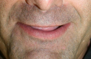 dentures-full-before-after-1