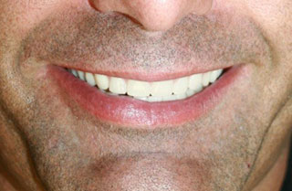 dentures-full-before-after-2